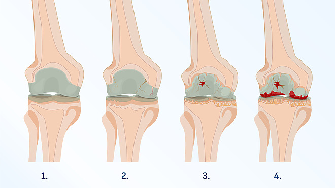 Grados de la artrosis de rodilla