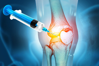 Artrosis de rodilla - inyecciones
